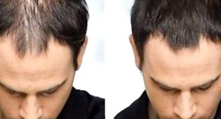 Las mejores clínica injerto capilar en Ares - Las mejores clínica
